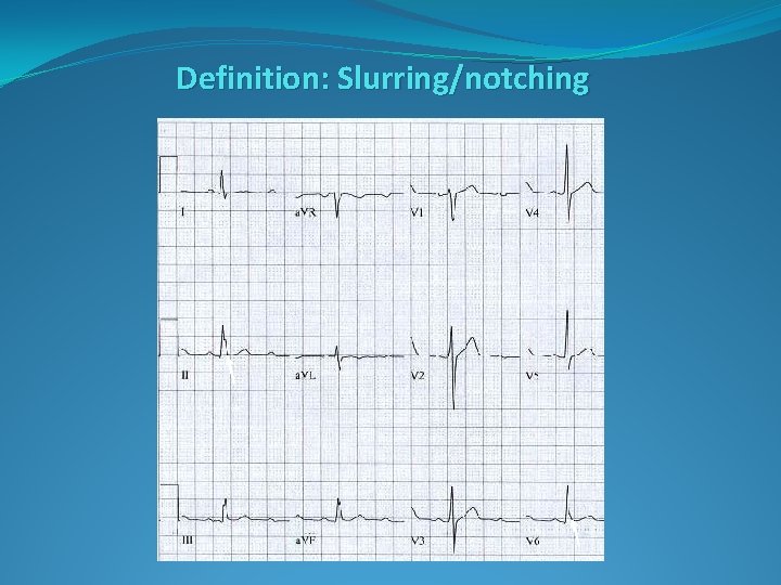 Definition: Slurring/notching Definition: Slurring/notching