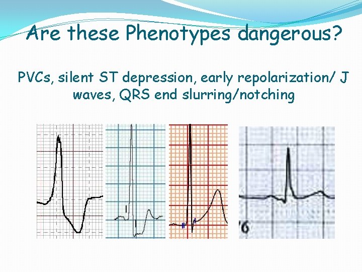Are these Phenotypes dangerous? PVCs, silent ST depression, early repolarization/ J waves, QRS end Are these Phenotypes dangerous? PVCs, silent ST depression, early repolarization/ J waves, QRS end