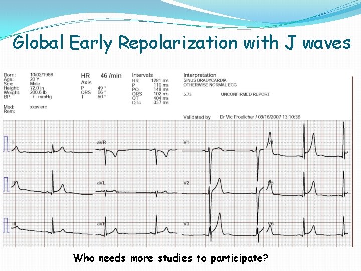 Global Early Repolarization with J waves Who needs more studies to participate? Global Early Repolarization with J waves Who needs more studies to participate?