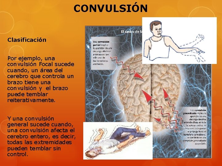 CONVULSIÓN Clasificación Por ejemplo, una convulsión Focal sucede cuando, un área del cerebro que