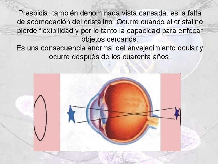 Presbicia: también denominada vista cansada, es la falta de acomodación del cristalino. Ocurre cuando