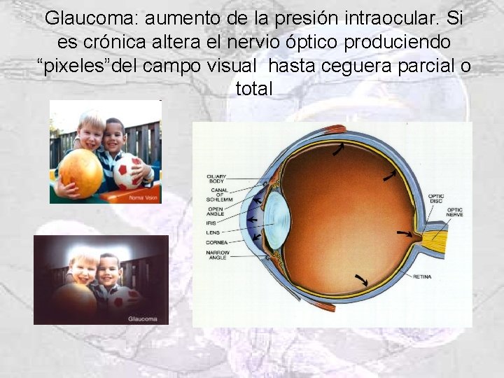 Glaucoma: aumento de la presión intraocular. Si es crónica altera el nervio óptico produciendo