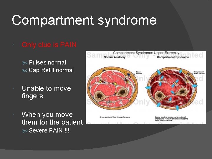 Compartment syndrome Only clue is PAIN Pulses normal Cap Refill normal Unable to move
