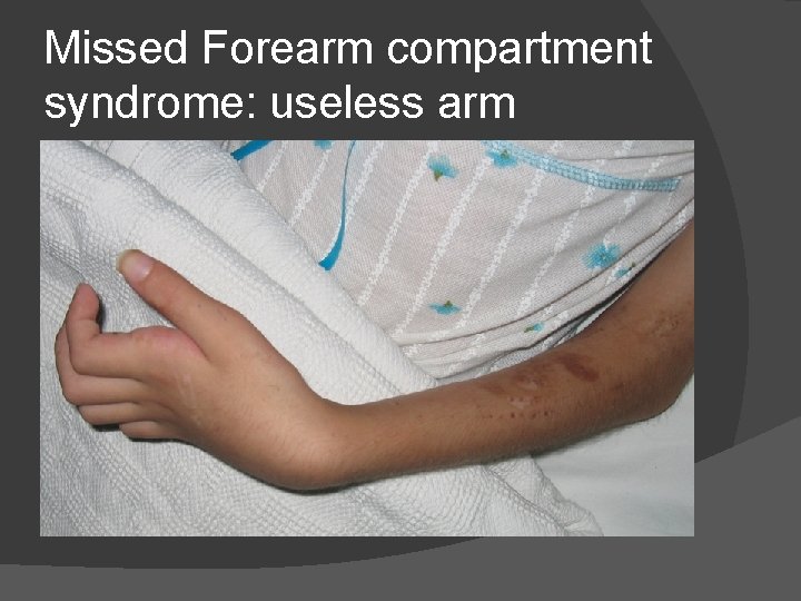 Missed Forearm compartment syndrome: useless arm 