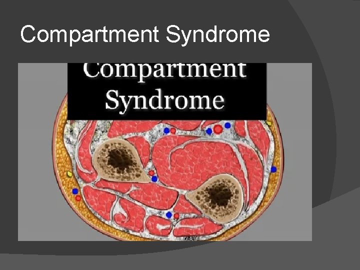 Compartment Syndrome 
