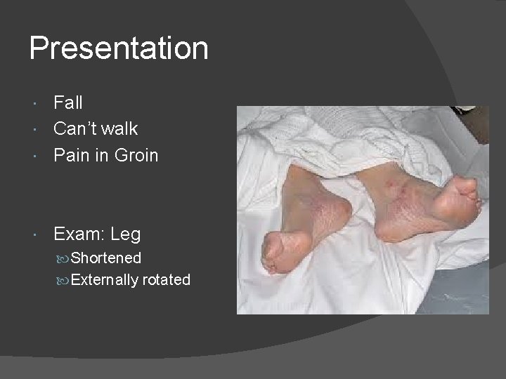 Presentation Fall Can’t walk Pain in Groin Exam: Leg Shortened Externally rotated 