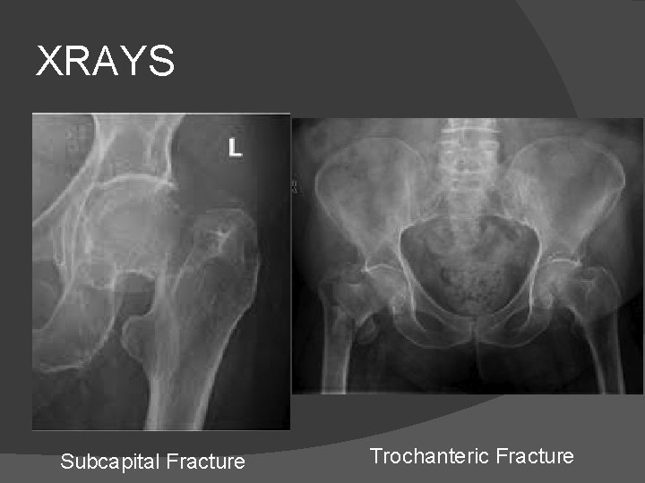 XRAYS Subcapital Fracture Trochanteric Fracture 