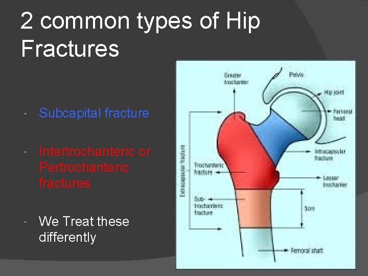 2 common types of Hip Fractures Subcapital fracture Intertrochanteric or Pertrochanteric fractures We Treat