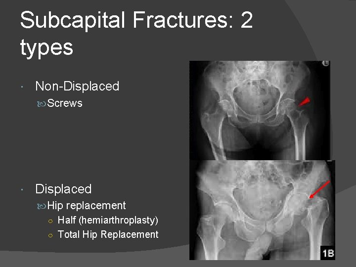 Subcapital Fractures: 2 types Non-Displaced Screws Displaced Hip replacement ○ Half (hemiarthroplasty) ○ Total