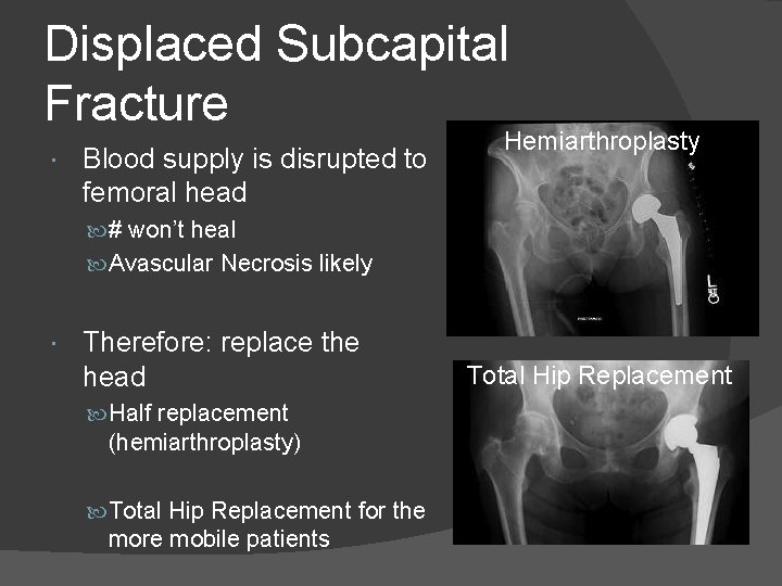 Displaced Subcapital Fracture Blood supply is disrupted to femoral head Hemiarthroplasty # won’t heal
