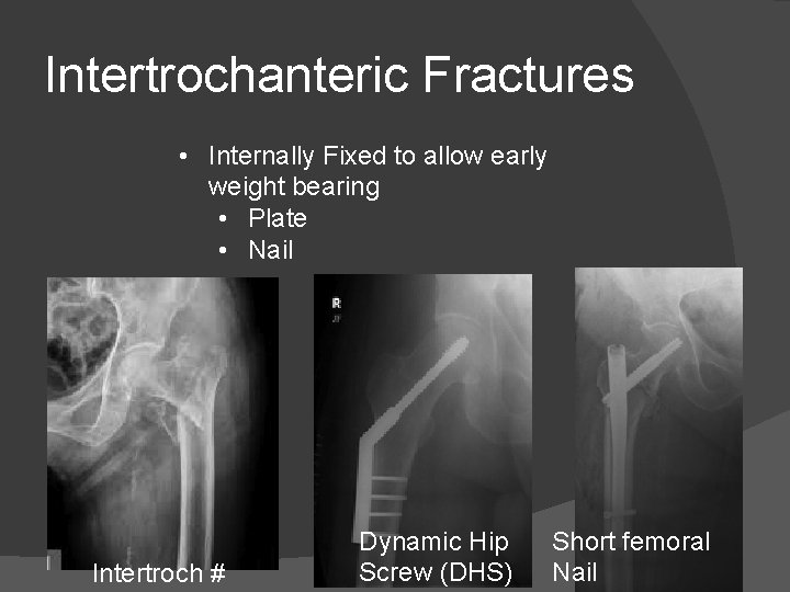 Intertrochanteric Fractures • Internally Fixed to allow early weight bearing • Plate • Nail
