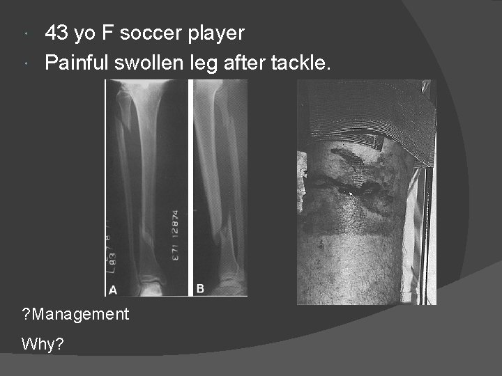 43 yo F soccer player Painful swollen leg after tackle. ? Management Why? 