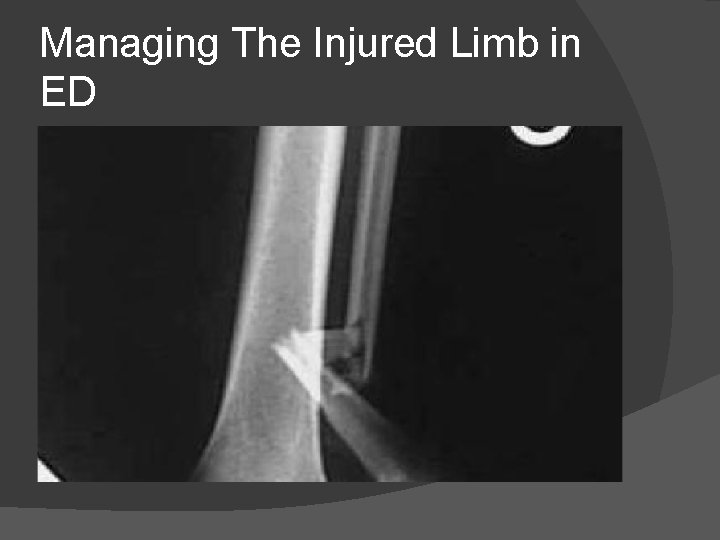 Managing The Injured Limb in ED 