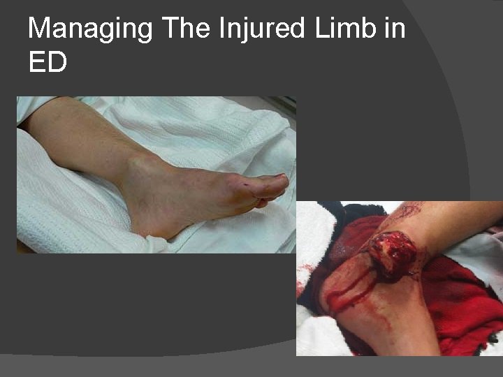 Managing The Injured Limb in ED 