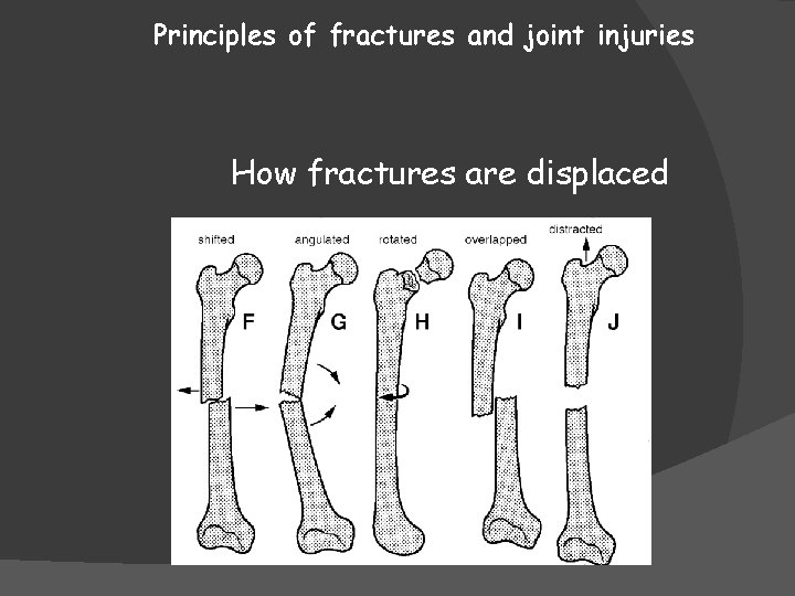 Principles of fractures and joint injuries How fractures are displaced 