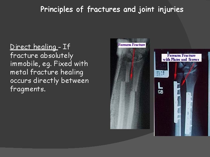 Principles of fractures and joint injuries Direct healing - If fracture absolutely immobile, eg.