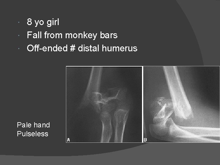 8 yo girl Fall from monkey bars Off-ended # distal humerus Pale hand Pulseless