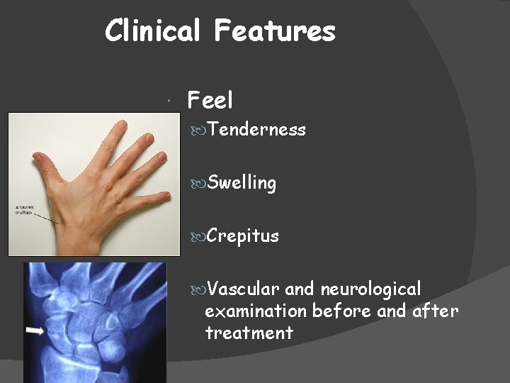 Clinical Features Feel Tenderness Swelling Crepitus Vascular and neurological examination before and after treatment