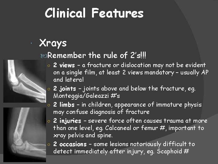 Clinical Features Xrays Remember the rule of 2’s!!! ○ 2 views – a fracture