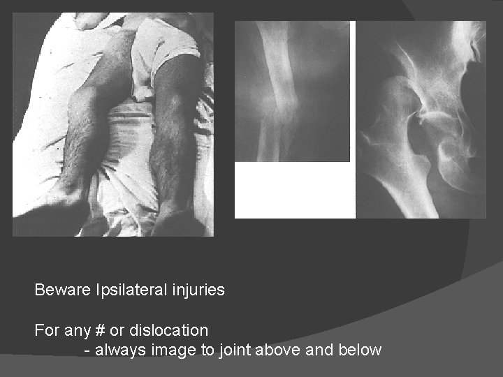 Beware Ipsilateral injuries For any # or dislocation - always image to joint above