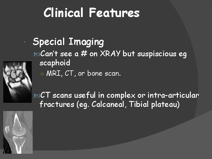 Clinical Features Special Imaging Can’t see a # on XRAY but suspiscious eg scaphoid