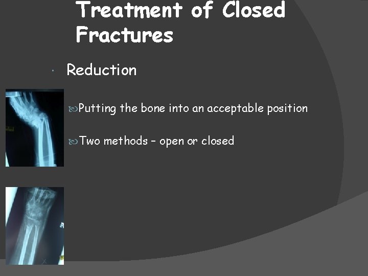 Treatment of Closed Fractures Reduction Putting the bone into an acceptable position Two methods