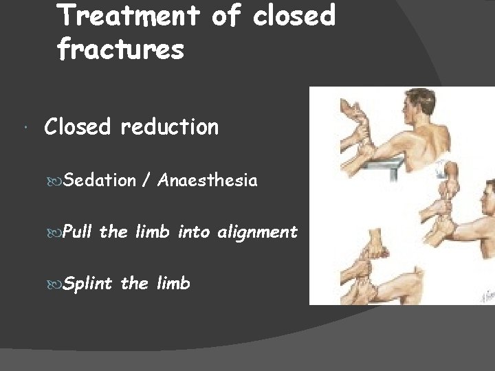 Treatment of closed fractures Closed reduction Sedation / Anaesthesia Pull the limb into alignment