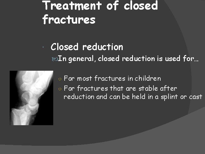 Treatment of closed fractures Closed reduction In general, closed reduction is used for… ○