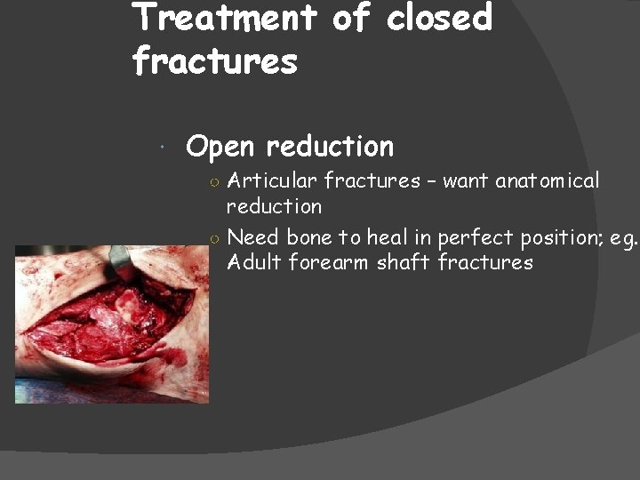 Treatment of closed fractures Open reduction ○ Articular fractures – want anatomical reduction ○