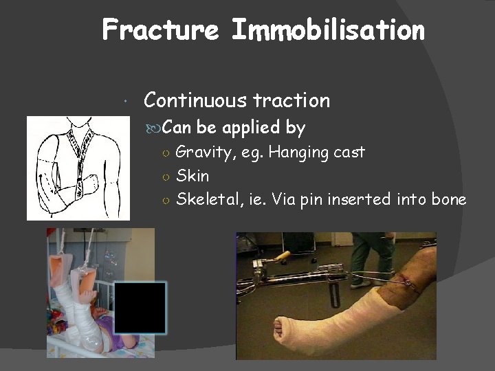 Fracture Immobilisation Continuous traction Can be applied by ○ Gravity, eg. Hanging cast ○
