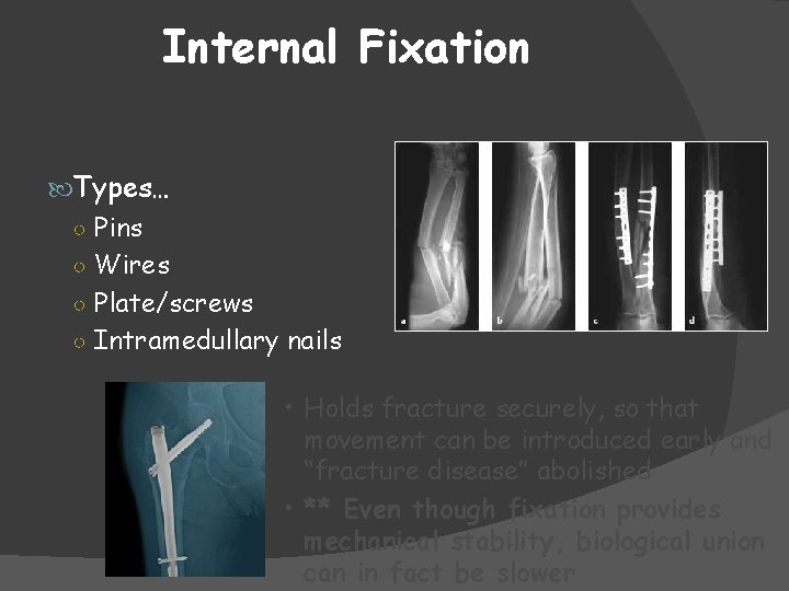 Internal Fixation Types… ○ Pins ○ Wires ○ Plate/screws ○ Intramedullary nails • Holds