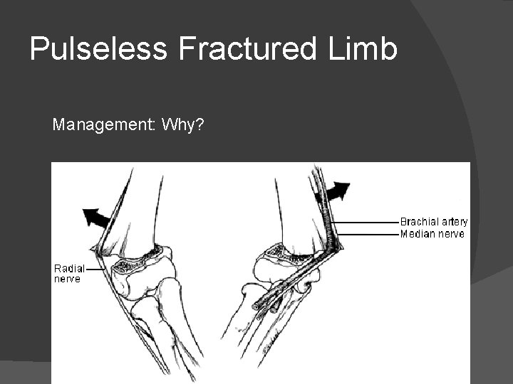 Pulseless Fractured Limb Management: Why? 