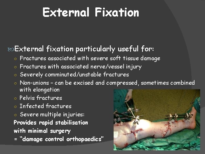 External Fixation External fixation particularly useful for: ○ Fractures associated with severe soft tissue