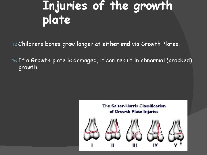 Injuries of the growth plate Childrens bones grow longer at either end via Growth