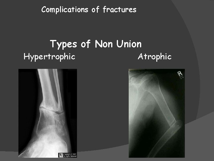 Complications of fractures Types of Non Union Hypertrophic Atrophic 