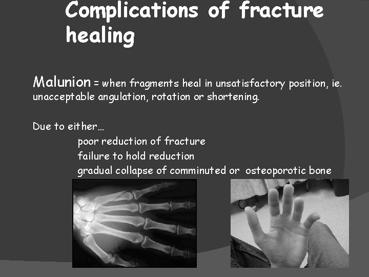 Complications of fracture healing Malunion = when fragments heal in unsatisfactory position, ie. unacceptable