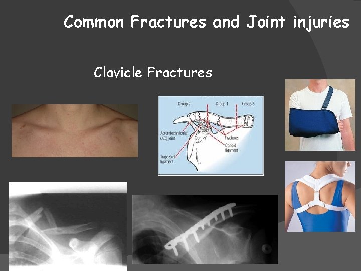 Common Fractures and Joint injuries Clavicle Fractures 