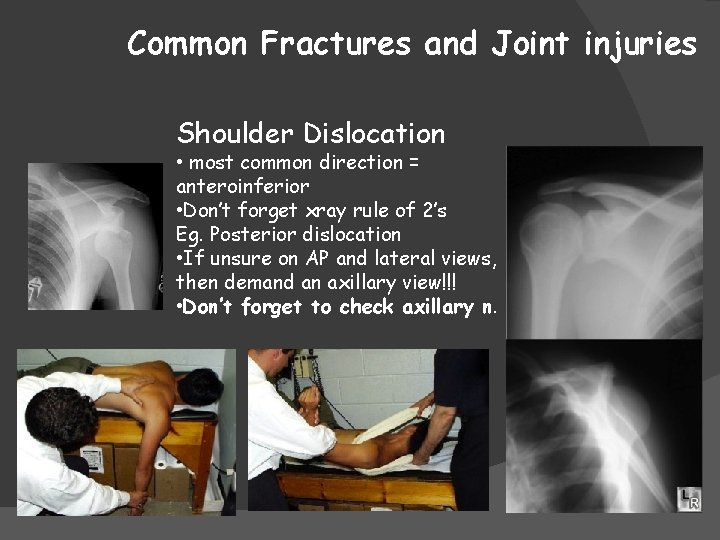 Common Fractures and Joint injuries Shoulder Dislocation • most common direction = anteroinferior •