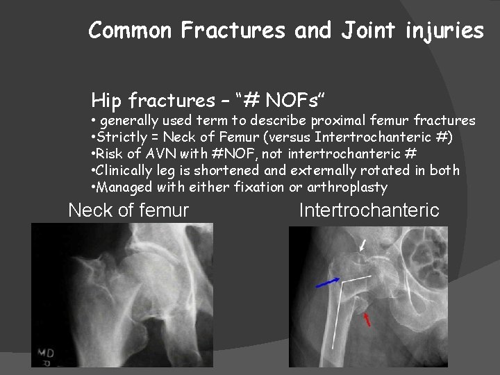 Common Fractures and Joint injuries Hip fractures – “# NOFs” • generally used term