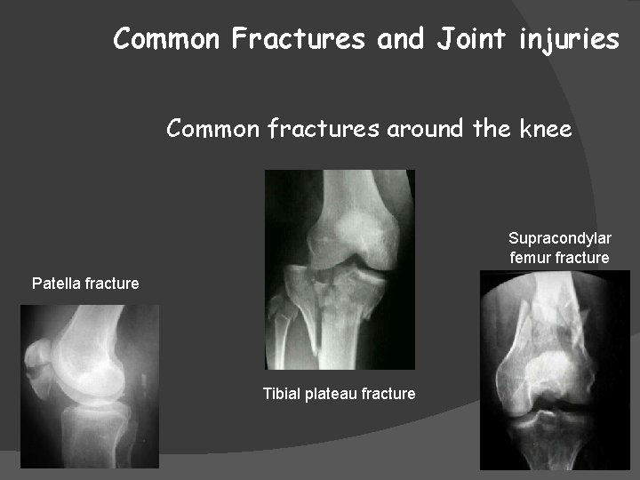 Common Fractures and Joint injuries Common fractures around the knee Supracondylar femur fracture Patella