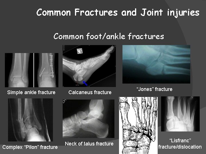 Common Fractures and Joint injuries Common foot/ankle fractures Simple ankle fracture Complex “Pilon” fracture