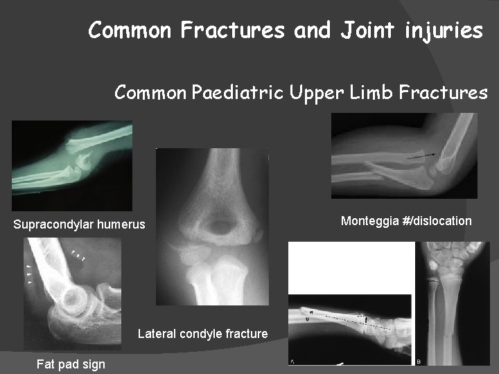 Common Fractures and Joint injuries Common Paediatric Upper Limb Fractures Supracondylar humerus Monteggia #/dislocation