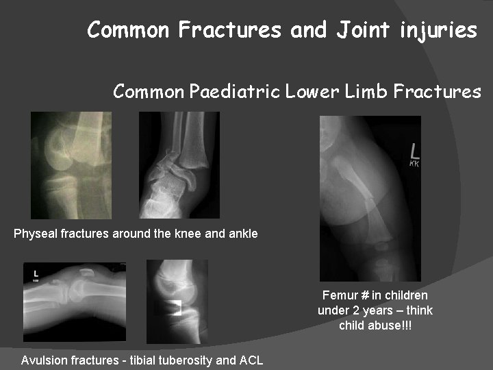 Common Fractures and Joint injuries Common Paediatric Lower Limb Fractures Physeal fractures around the