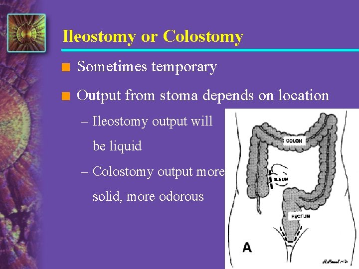 Ileostomy or Colostomy n Sometimes temporary n Output from stoma depends on location –