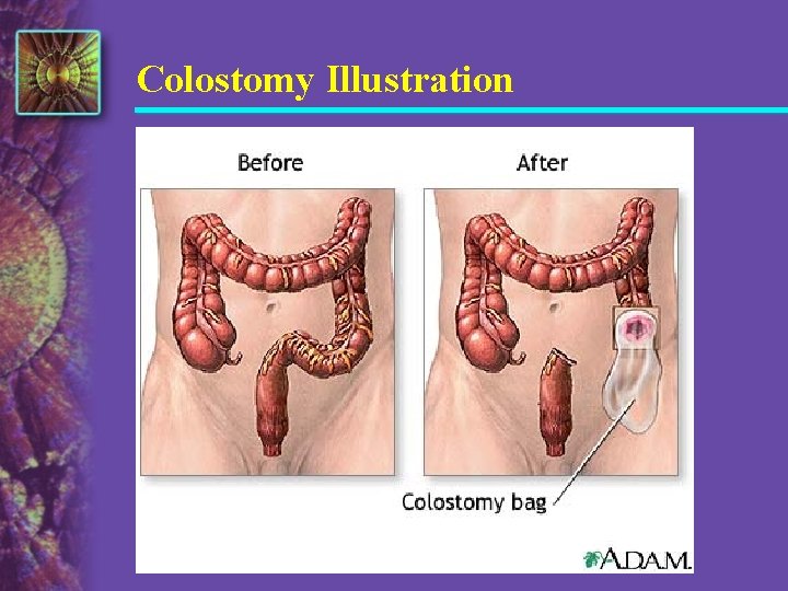 Colostomy Illustration 
