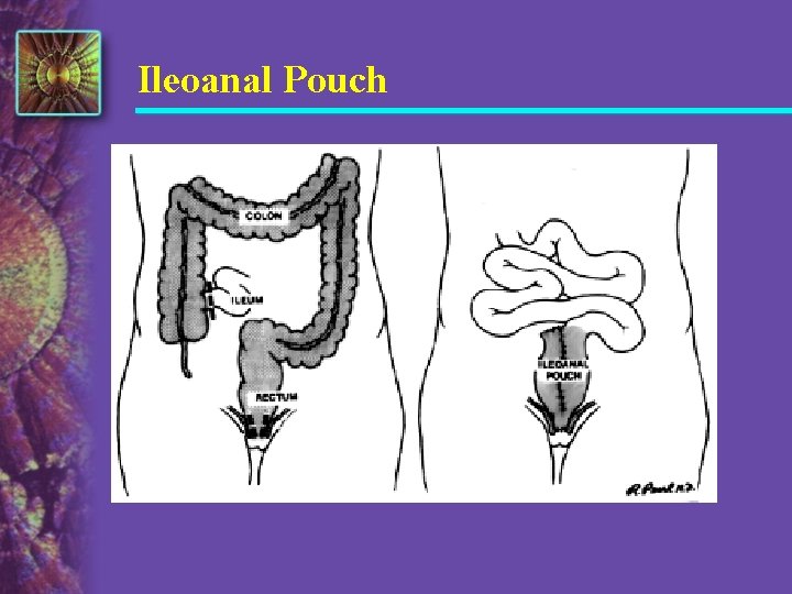 Ileoanal Pouch 