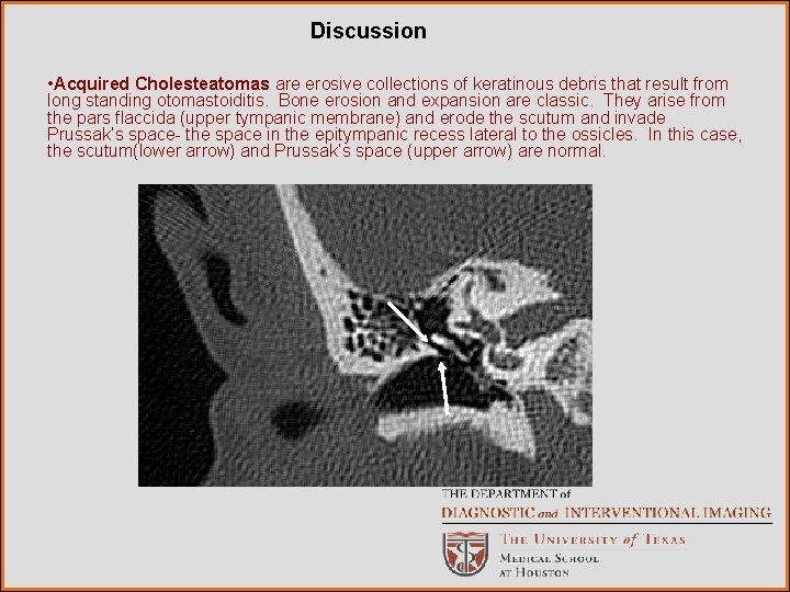 Discussion • Acquired Cholesteatomas are erosive collections of keratinous debris that result from long
