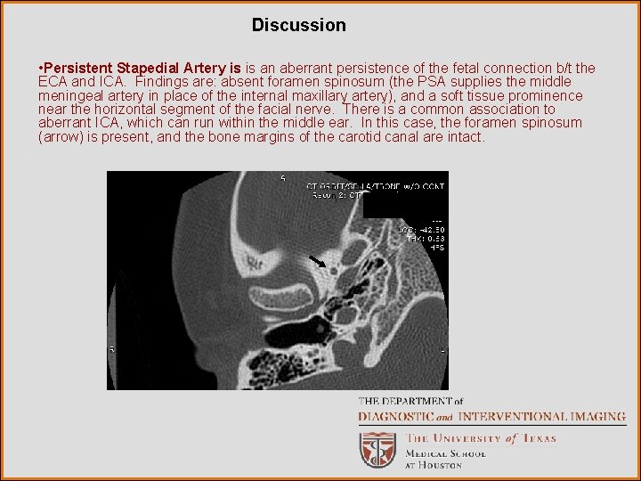 Discussion • Persistent Stapedial Artery is is an aberrant persistence of the fetal connection