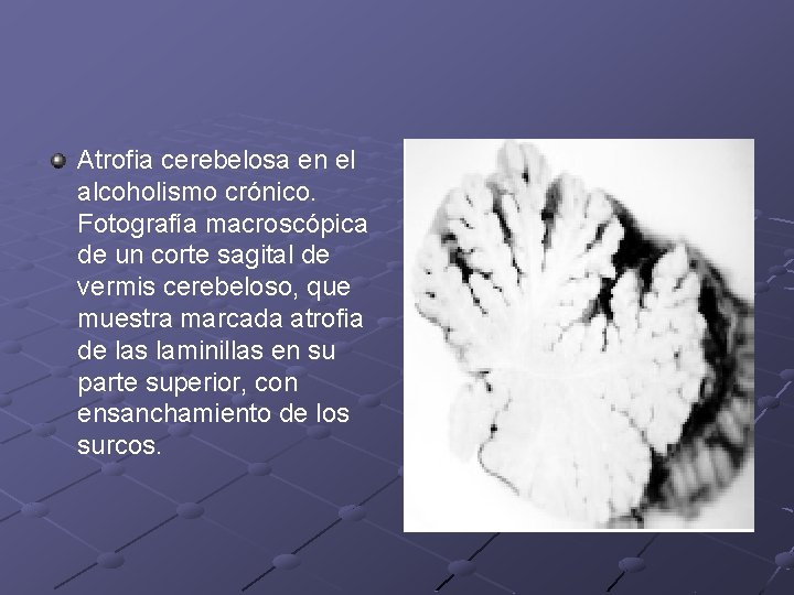 Atrofia cerebelosa en el alcoholismo crónico. Fotografía macroscópica de un corte sagital de vermis Atrofia cerebelosa en el alcoholismo crónico. Fotografía macroscópica de un corte sagital de vermis