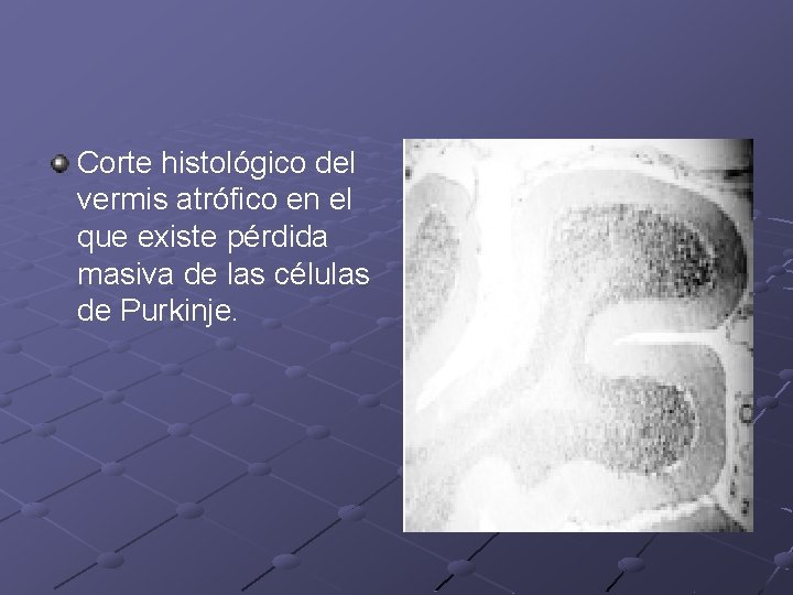 Corte histológico del vermis atrófico en el que existe pérdida masiva de las células Corte histológico del vermis atrófico en el que existe pérdida masiva de las células